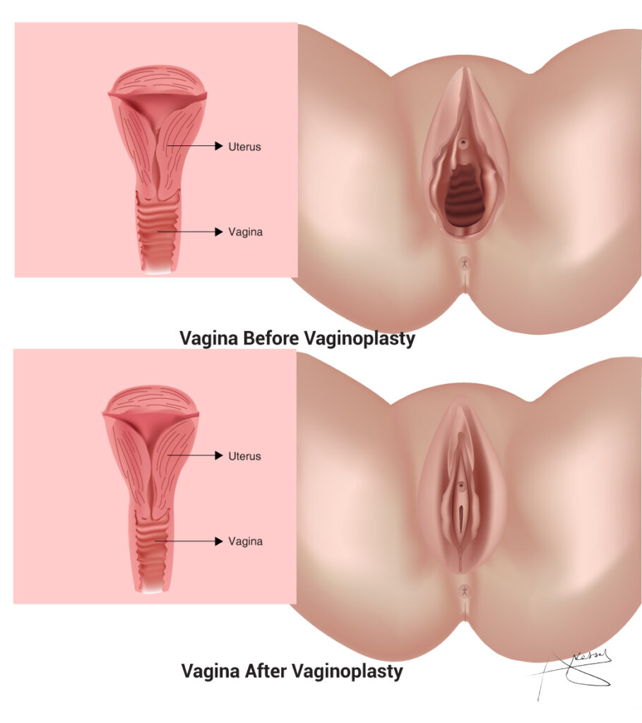 3 holes in the vagina