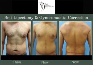 gynaecomastia