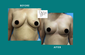 Breast Implant Result Mumbai