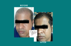 Hair Transplant Result