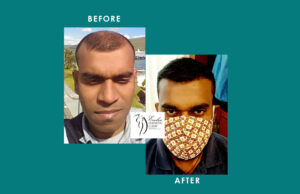 Hair Transplant