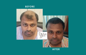 Hair Transplant