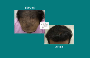 Hair Transplant