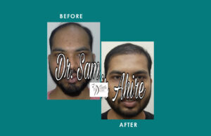 Hair Transplant Result